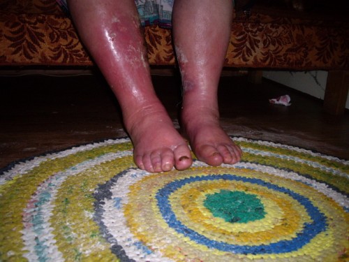 В Сорочинске отмороженными ногами в больницу доставили женщина