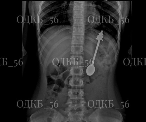 Ребенок поглотил ложку длиной 14 см: оренбургские врачи без разрезов спасли ребенка