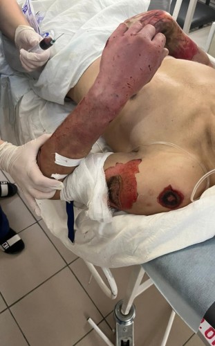 В Оренбурге мужчина ударило током, врачам пришлось ампутировать руку 