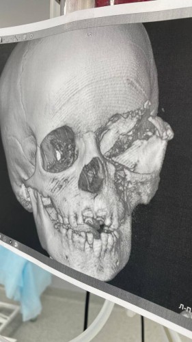 В Оренбуржье жеребёнок ударил копытом по голове пятилетнего мальчика В Оренбуржье жеребёнок ударил копытом по голове пятилетнего мальчика