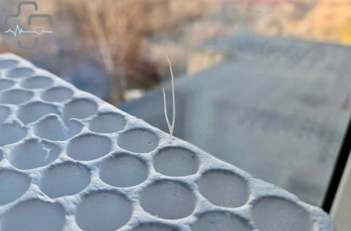 В Орске врачи спасли пациента с костью в горле