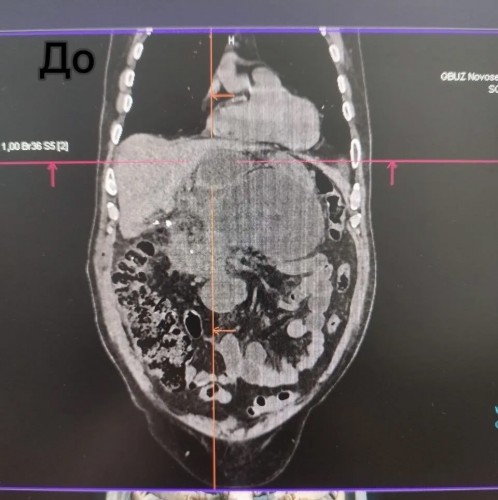 В Новосергиевском районе врачи спасли пациента от опасного заболевания