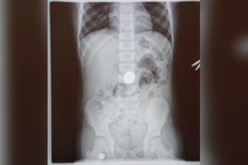 В Бузулуке 2-летняя девочка проглотила монету В Бузулуке 2-летняя девочка проглотила монету